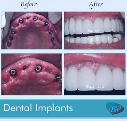 Cost of Dental Implants in West Hollywood and Beverly Hills, CA